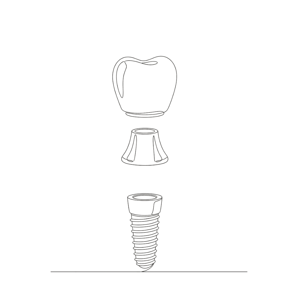 Dental Implant